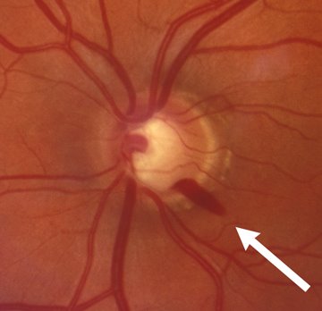 fundus phot showing a flame hemorrhage